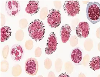 Острый промиелоцитарный лейкоз (миелограмма)