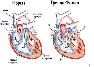 1 — стеноз лёгочной артерии,      2 — гипертрофия правого желудочка,   3 — дефект межпредсердной перегородки