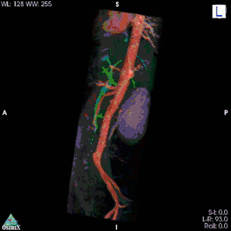 МРТ. Брюшная аорта и соседствующие органы (расположение печени и селезёнки нехарактерно)