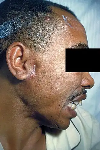 Больной с актиномикозом лица.