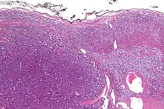 Адренокортикальный рак