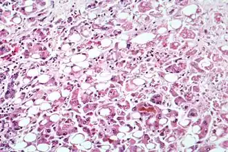 Микрофотография клеток печени, поражённой алкогольным гепатитом