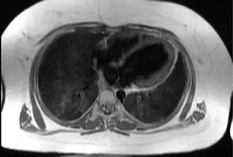 Трансаксиальное изображение грудной клетки на уровне сердца, иллюстрирующее типичную жировую ткань подкожно и эпикардиально у пациента с синдромом Альстрёма.
