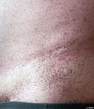 Ангиокератома туловища — клинический признак, ассоциированный с β-маннозидозом