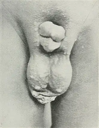 Эписпадия у мужчины