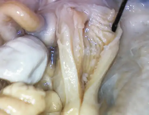 Лигула внутри яйцевода