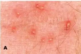 Укусы клеща на коже