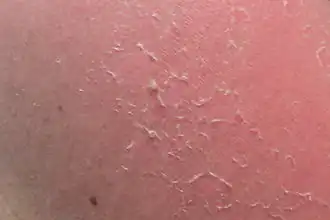 Шелушение кожи вследствие десквамации