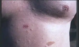 Наиболее выраженный признак нейрофиброматоза — пятна на коже цвета «кофе с молоком»