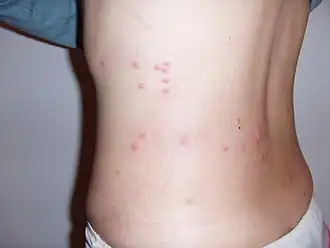 Следы от укусов блох