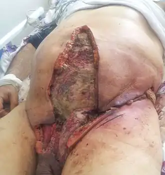 77-летний мужчина с гангреной Фурнье