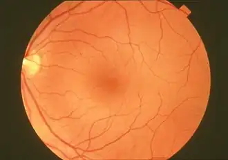 Сосудистая оболочка глаза человека в норме: диск зрительного нерва слева, макулярная область в центре.