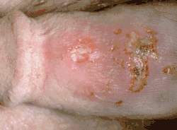 Генитальный герпес у мужчин. Везикулы, изъязвления и корочки на половом члене