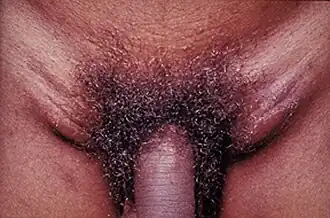 Типичное для болезни увеличение паховых лимфатических узлов