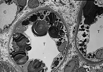 ТЭМ-микроскопия показывает наличие включений гликосфинголипидов различной формы и размеров в клетках дистальных канальцев почки.