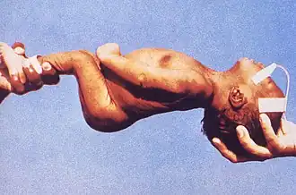 Приступ тетании у новорожденного.