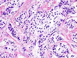 Панкреатическая инсулинома