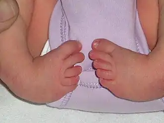 Двусторонняя косолапость