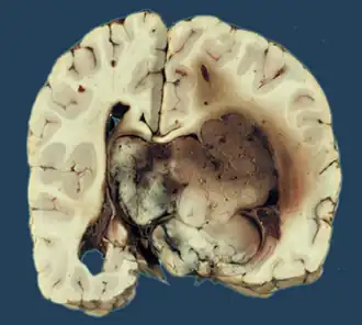 Макропрепарат хориоидпапилломы
