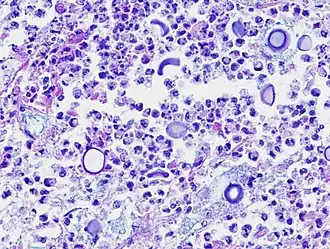 Микрофотография возбудителя заболевания