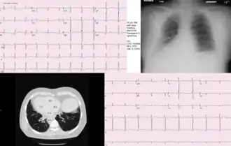 Транспозиция органов при синдроме Картагенера
