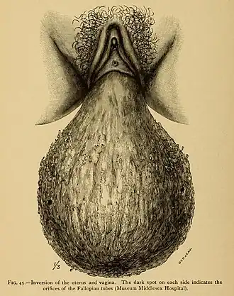Рисунок с полным выворотом матки