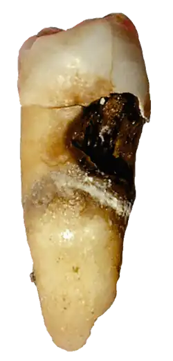 Расширенный кариес на премоляре