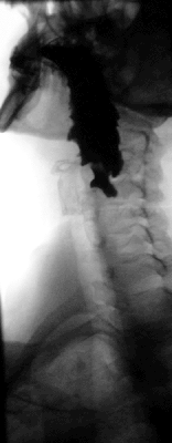 Дивертикул пищевода